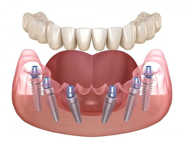 Имплантация зубов в семейной практике «Фамилия»